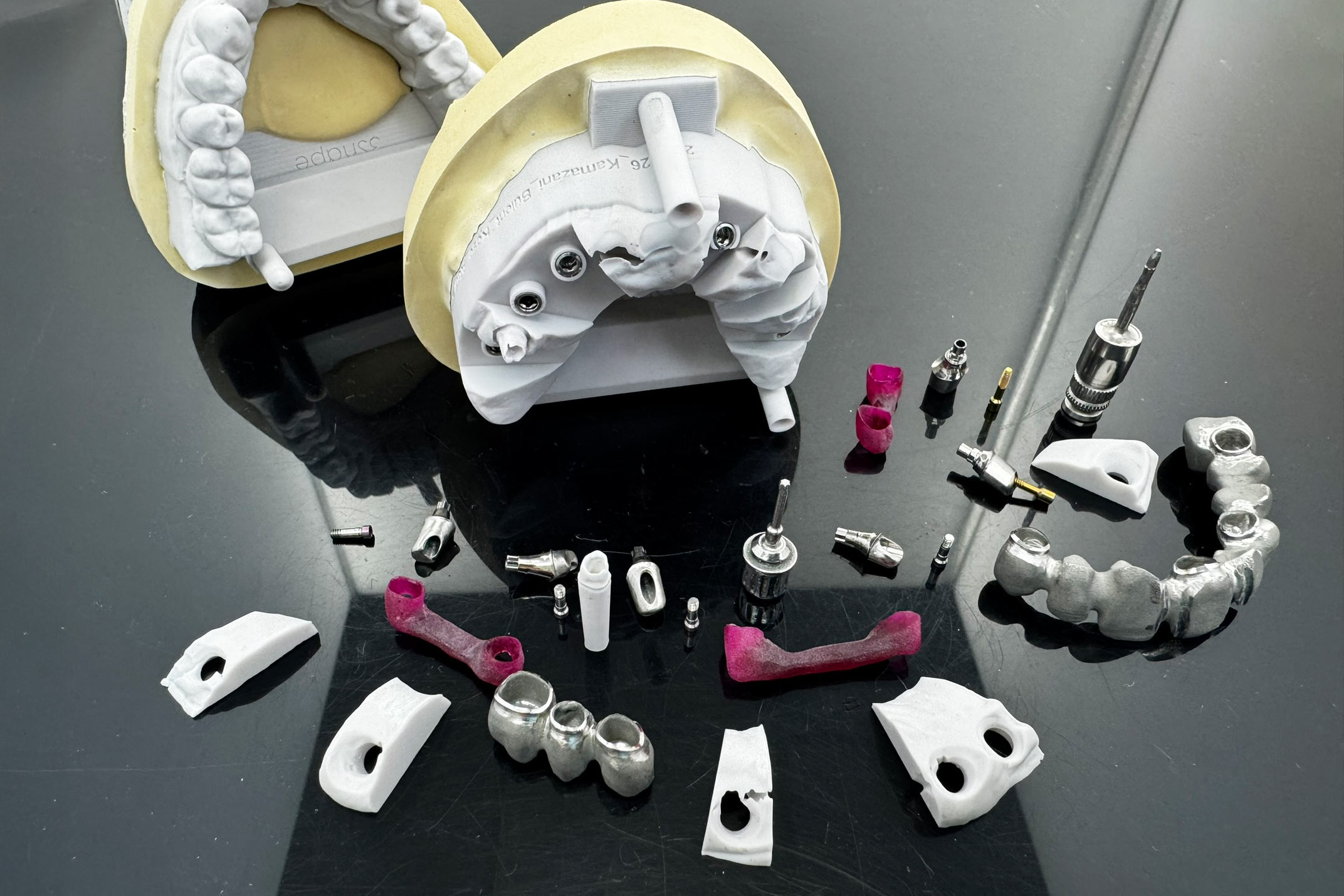 Implantatbrücke – IOS-Scan Emergenzprofil ausformen