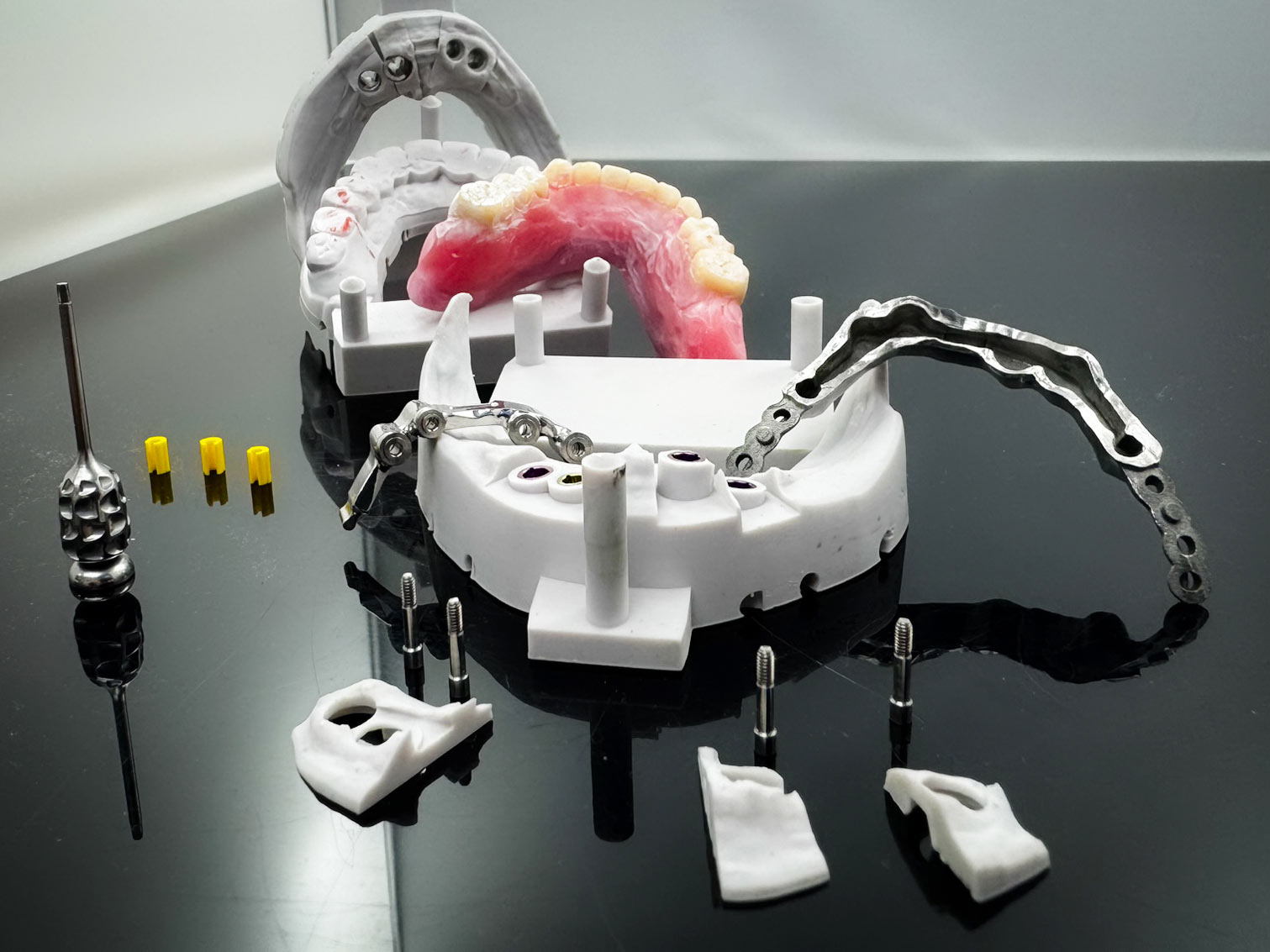 Steg auf Implantaten –Backward Planing Attachment