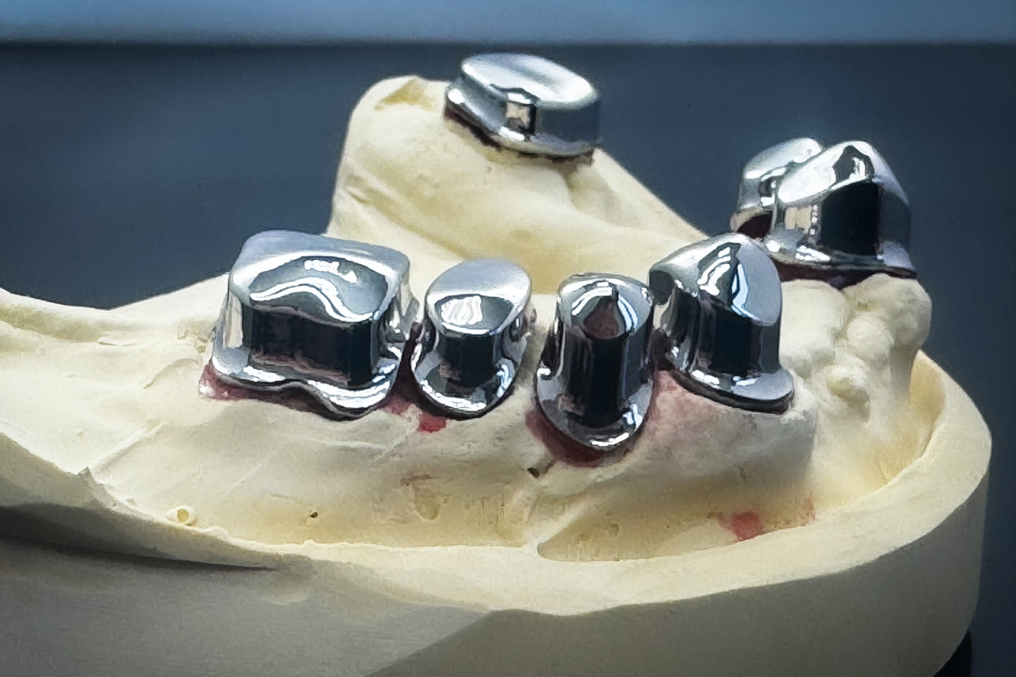 Polierte Primärkronen –additiver Workflow – alles an Platz rausholen – Mindeststärke-0,3 mm