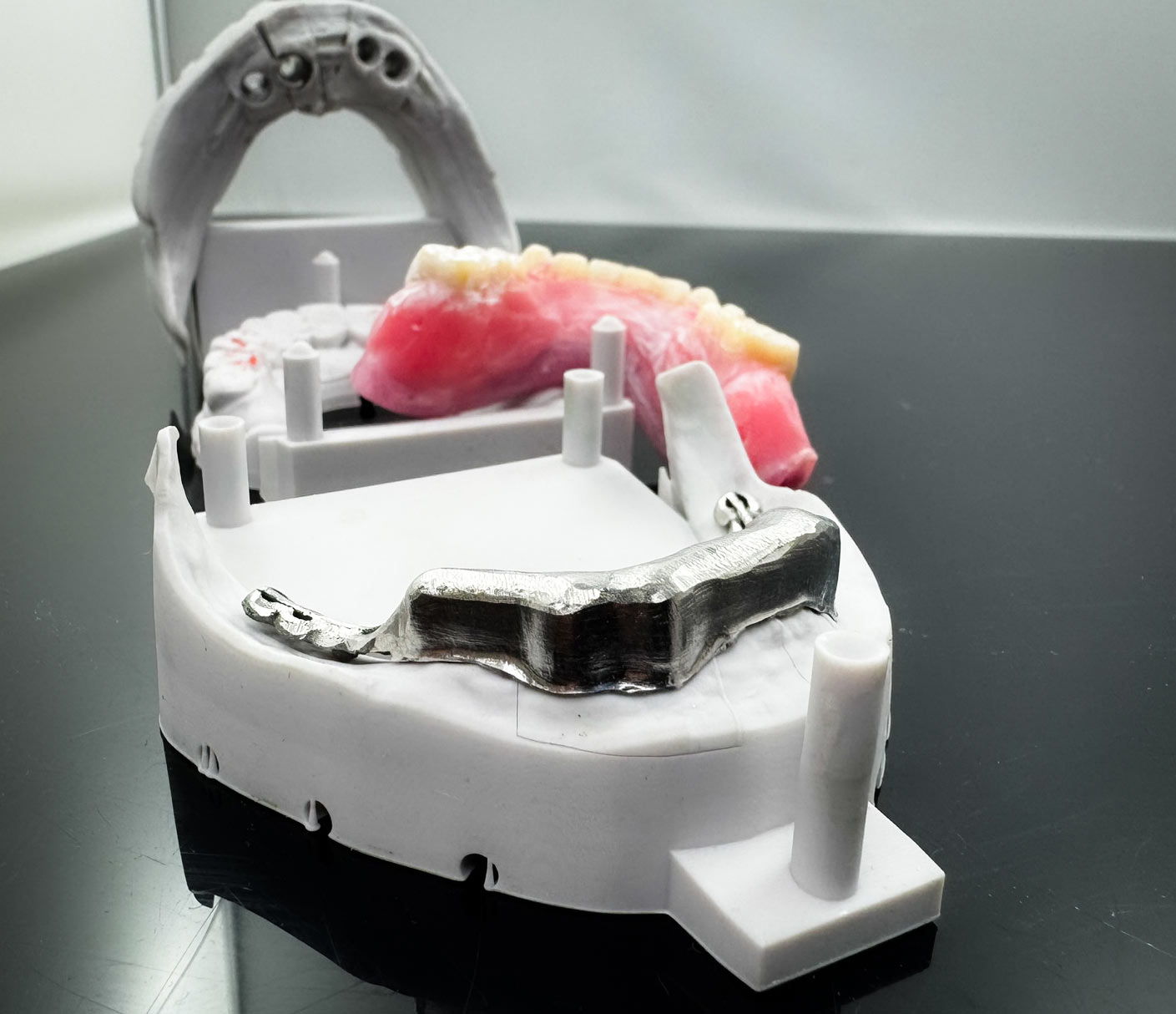 Steg-Geschiebe – Kombiarbeit Implantate – Primär und Sekundärgerüst